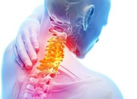Pain and shelter in the cervical zone with the third stage of osteochondrosis