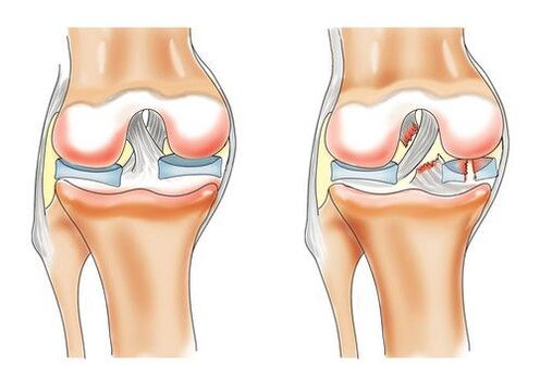 healthy knees and arthrosis of the knee joint